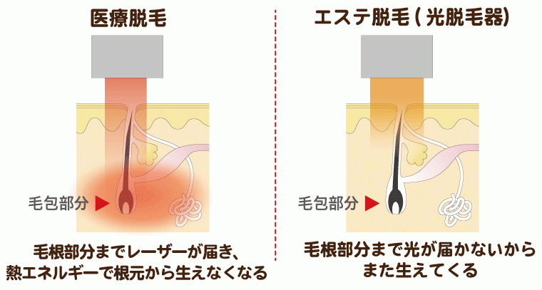 医療レーザー脱毛