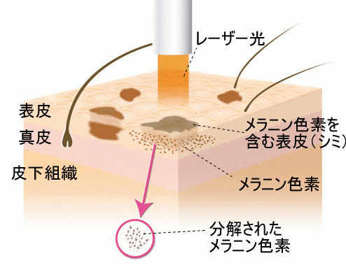 レーザーフェイシャル｜盛岡市のレディスクリニック